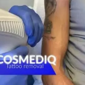 Tatoeage verwijderen cosmediq