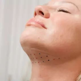 Kybella is administered as a series of injections to the treatment area under the chin, permanently destroying fat cells and producing gradual results. Everyone's chin profile is different, so we will tailor your treatment to you!