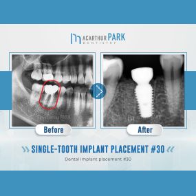 MacArthur Park Dentistry - Family Emergency Dental Implants Invisalign Dentist in Las Colinas & Irving, TX 75073