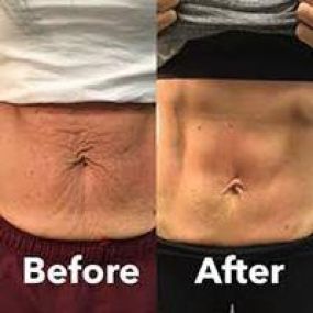 Tummy toning 2 treatments