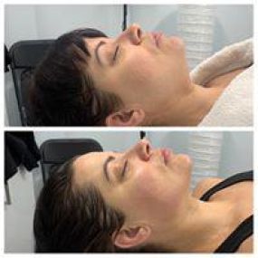 Female client facelift facial and added chin sculpting 1 treatment