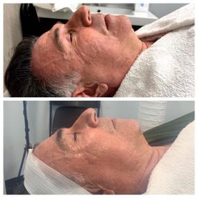 Male client cryo facial before and after 3 treatments