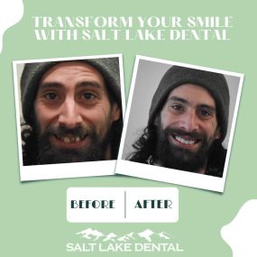 Smile Transformation in Salt Lake City at Salt Lake Dental