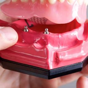 Mini Dental Implants (MDIs)