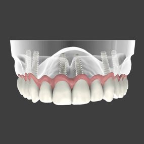 Implant-Supported Dentures