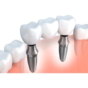 Implant-Supported Bridges