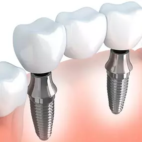 Implant-Supported Bridges