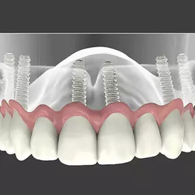 Implant-Supported Dentures