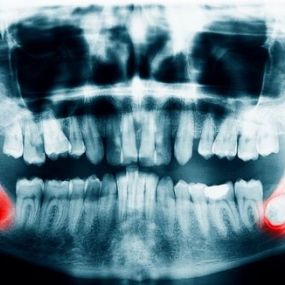 Wisdom Tooth Extraction in Charlotte, NC