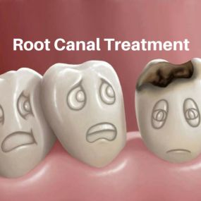 Root Canal Treatment Sioux City