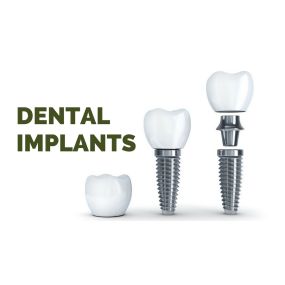 Dental Implants Sioux City