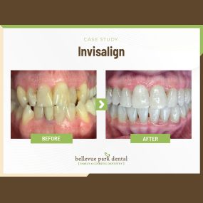 Case Study: Invisalign