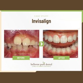 Case Study: Invisalign