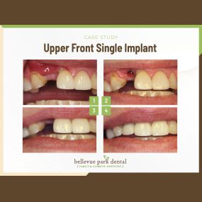 Case Study: Upper Front Single Implant