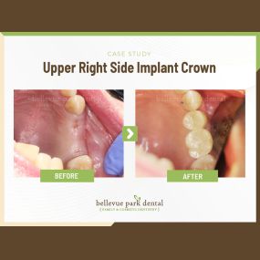 Case Study: Upper Right Side Implant Crown
