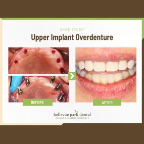 Case Study: Upper Implant Overdenture
