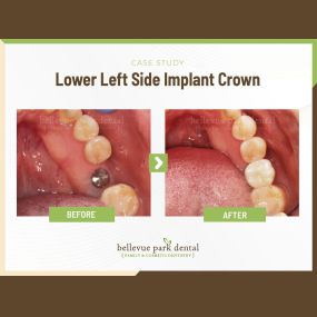 Case Study: Lower Left Side Implant Crown