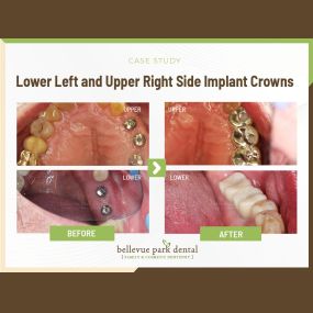 Case Study: Lower Left and Upper Right Side Implant Crowns