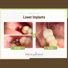 Case Study: Lower Implants