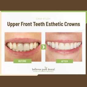 Case Study: Upper Front Teeth Esthetic Crowns
