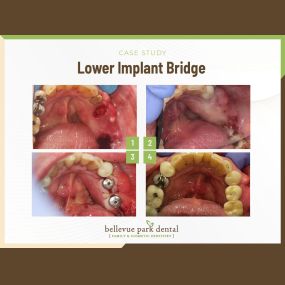 Case Study: Lower Implant Bridge