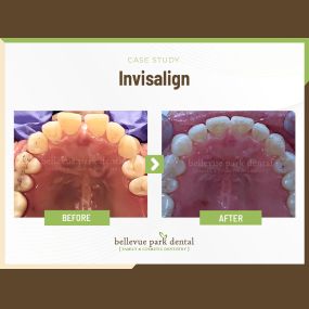 Case Study: Invisalign