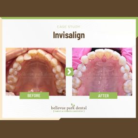 Case Study: Invisalign