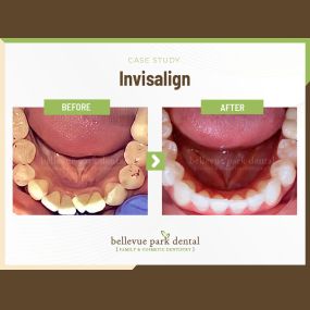 Case Study: Invisalign