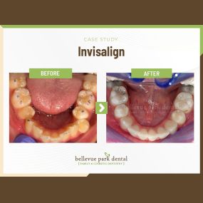 Case Study: Invisalign