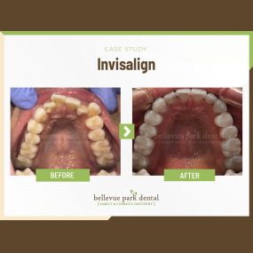 Case Study: Invisalign