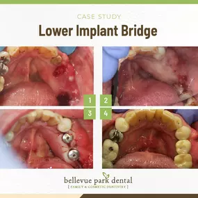 Case Study: Lower Implant Bridge