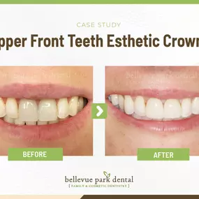 Case Study: Upper Front Teeth Esthetic Crowns