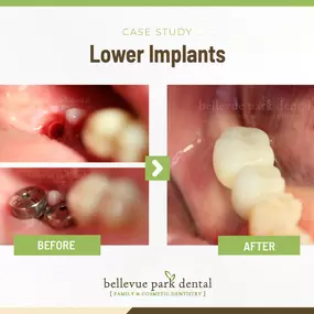 Case Study: Lower Implants