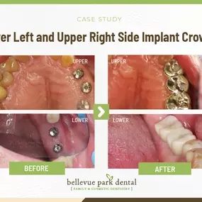 Case Study: Lower Left and Upper Right Side Implant Crowns