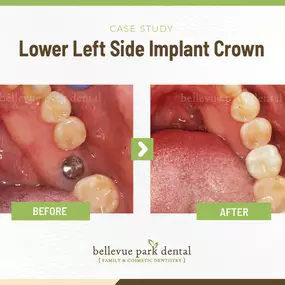 Case Study: Lower Left Side Implant Crown