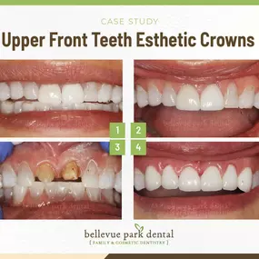 Case Study: Upper Front Teeth Esthetic Crowns