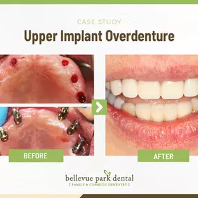 Case Study: Upper Implant Overdenture