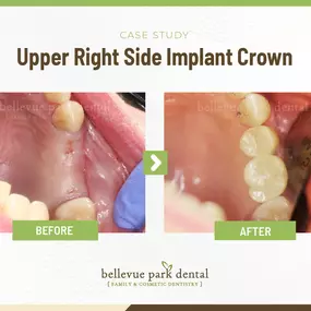 Case Study: Upper Right Side Implant Crown