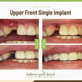 Case Study: Upper Front Single Implant