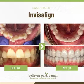 Case Study: Invisalign