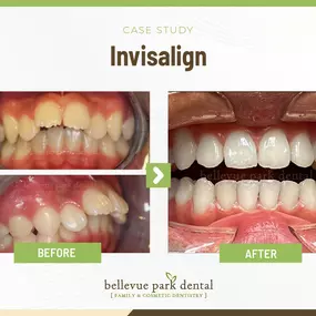 Case Study: Invisalign