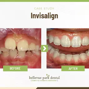 Case Study: Invisalign