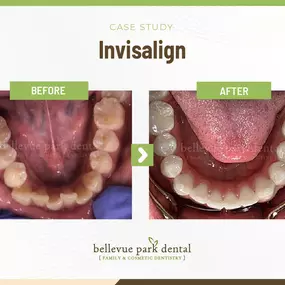 Case Study: Invisalign