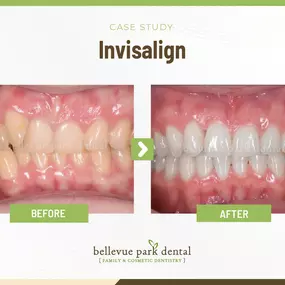 Case Study: Invisalign