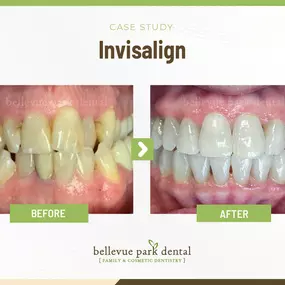 Case Study: Invisalign