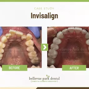 Case Study: Invisalign