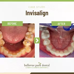 Case Study: Invisalign