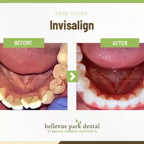 Case Study: Invisalign