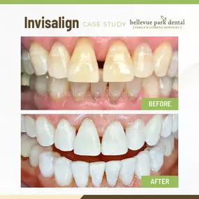 Case Study: Invisalign