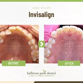 Case Study: Invisalign